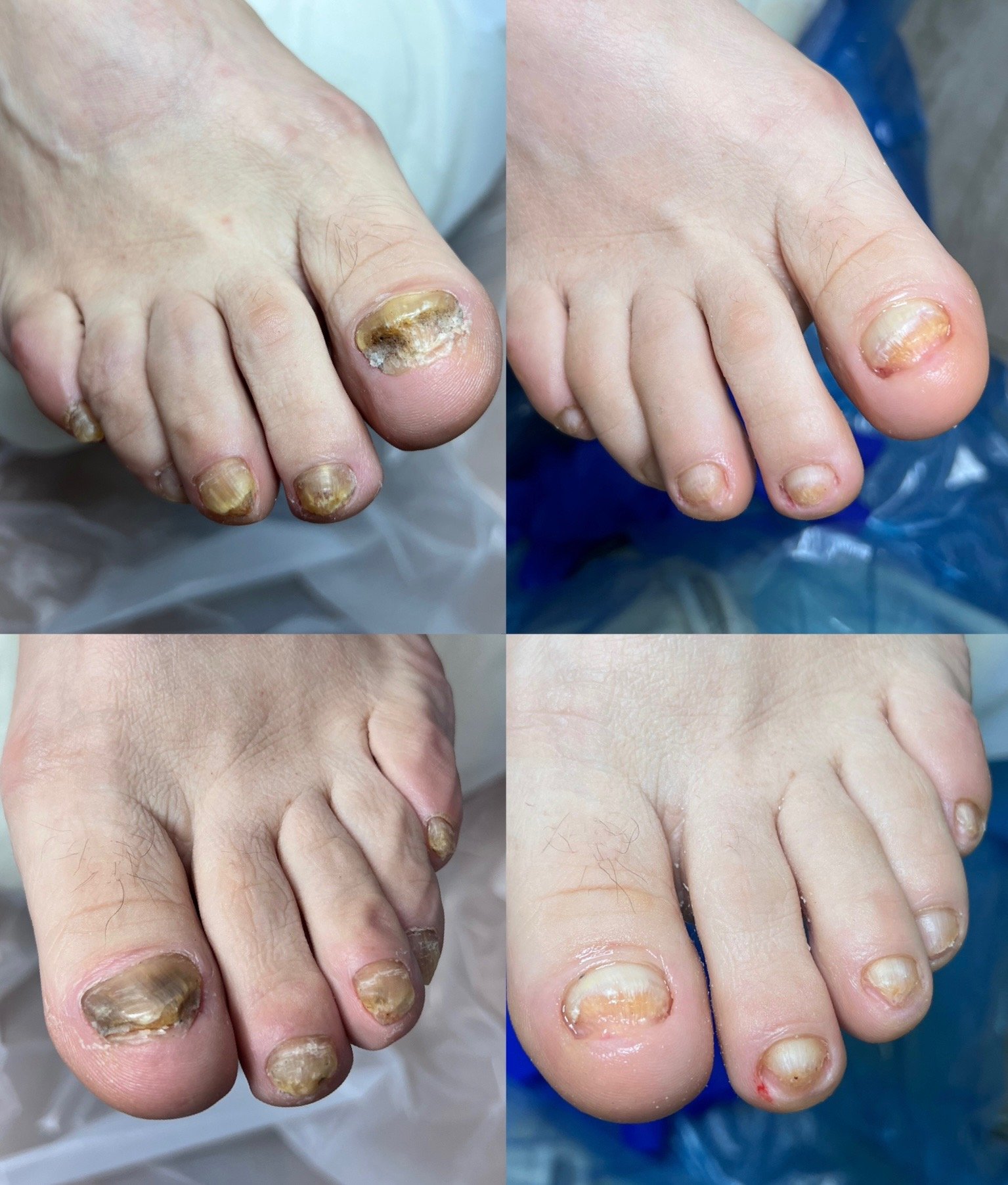 Peclavus Антимикотична тинктура 20мл.