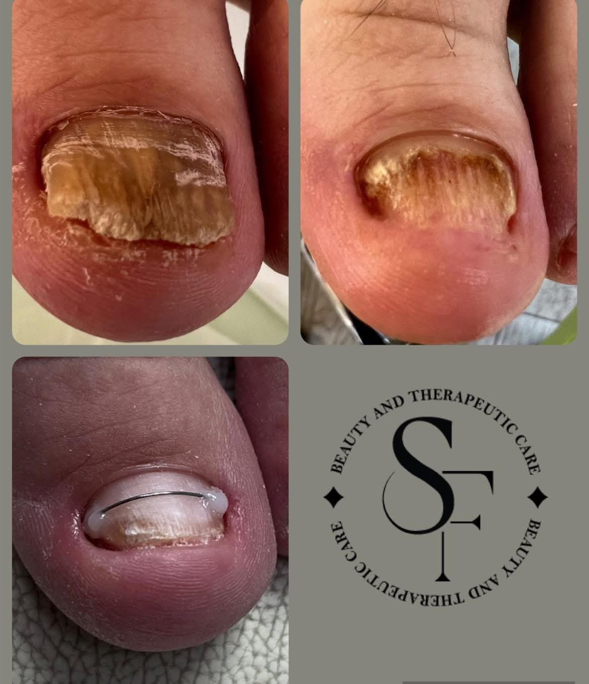 Комплект "Стоп на гъбичките"