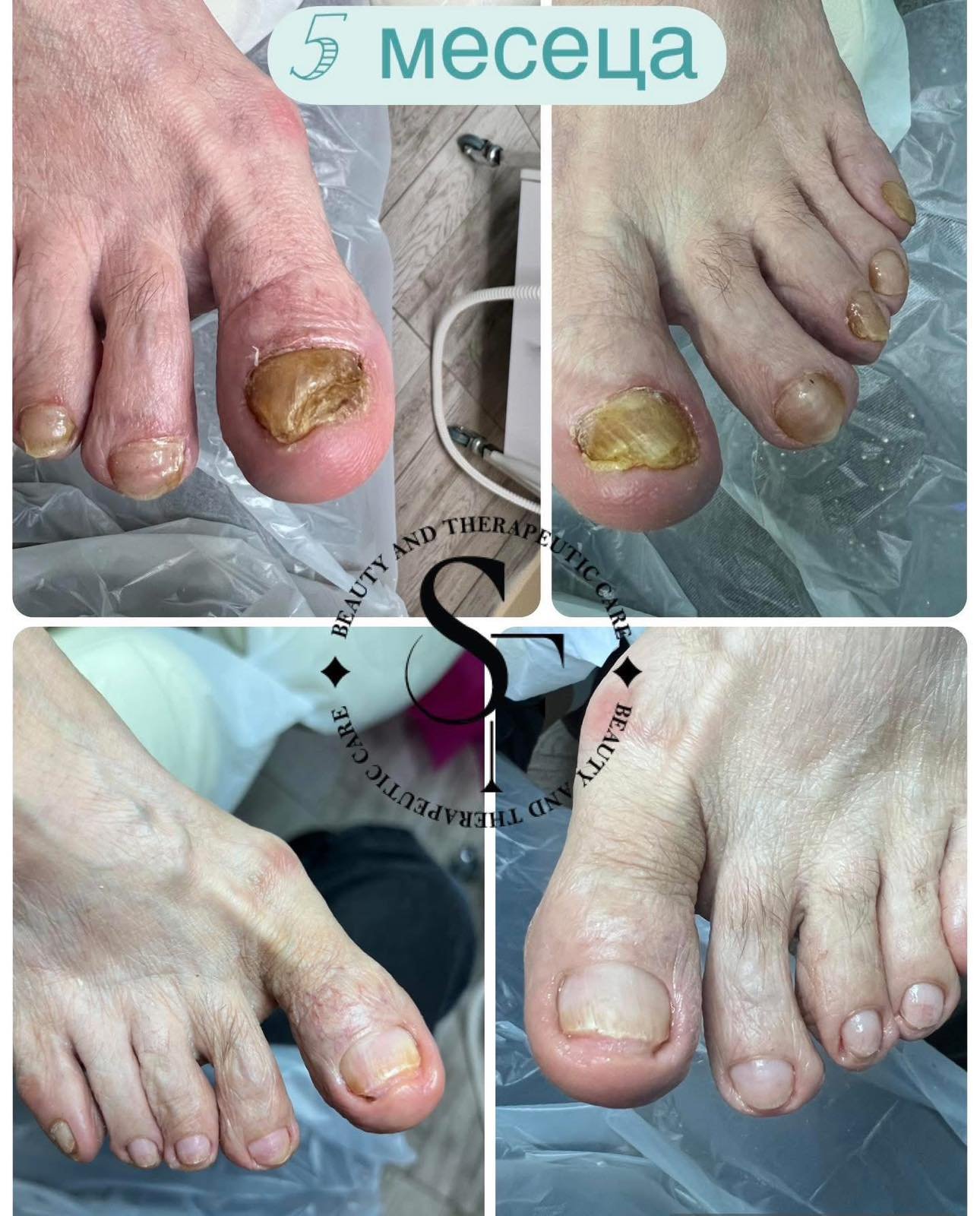 Комплект "Стоп на гъбичките"