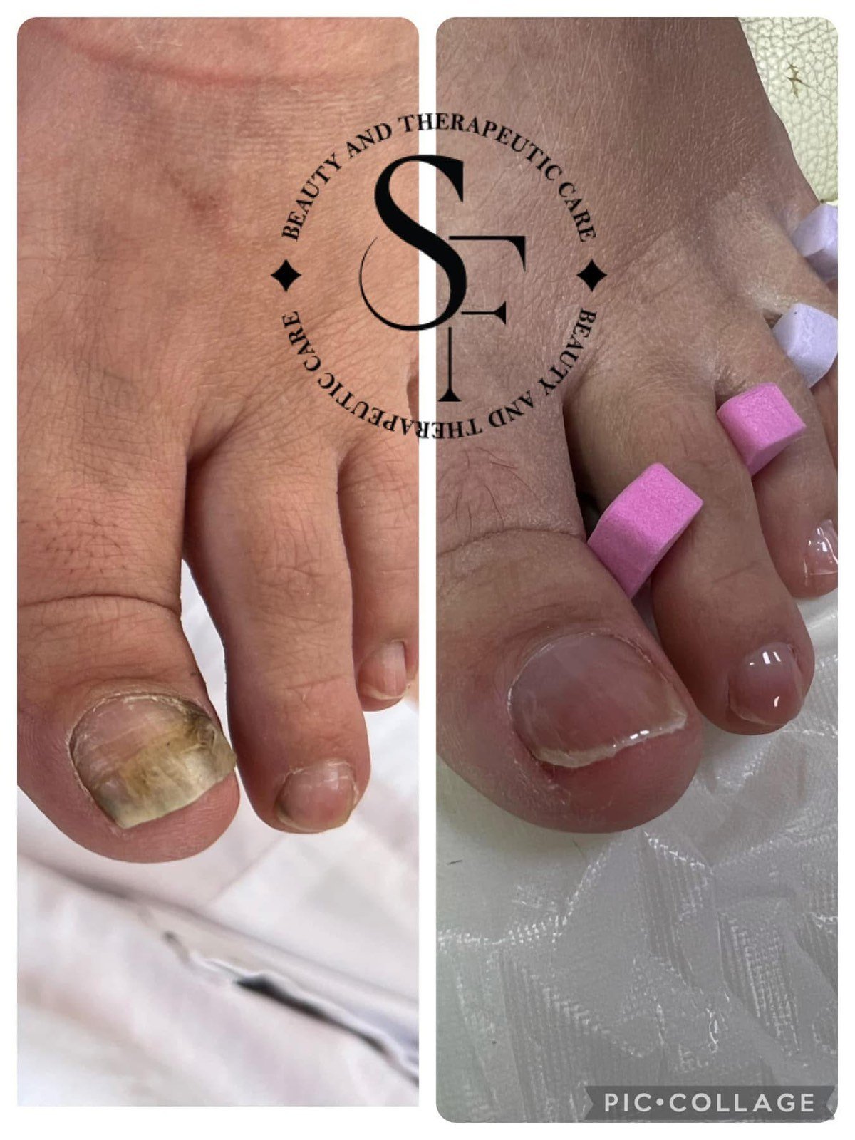 Комплект "Стоп на гъбичките"