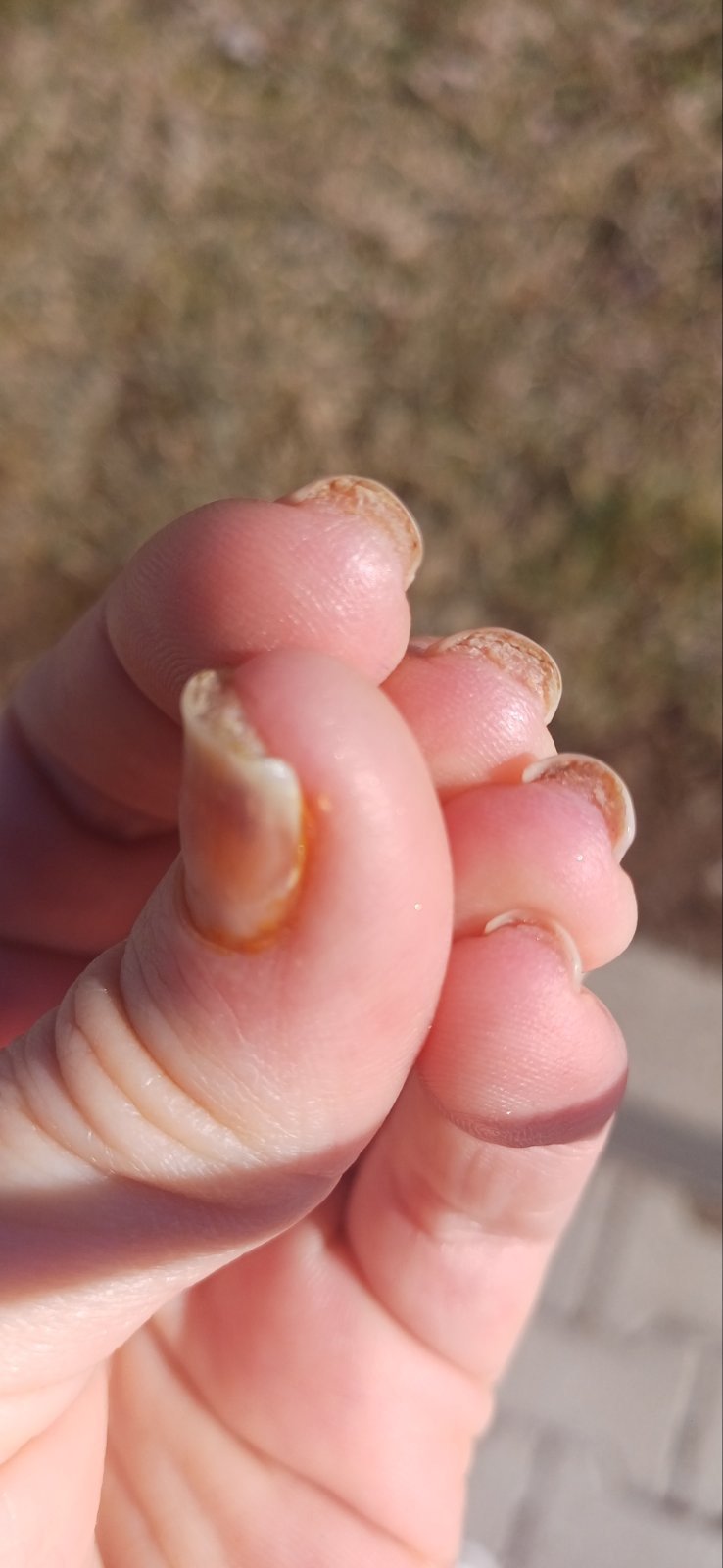 Комплект "Възстановяване" (ръце)